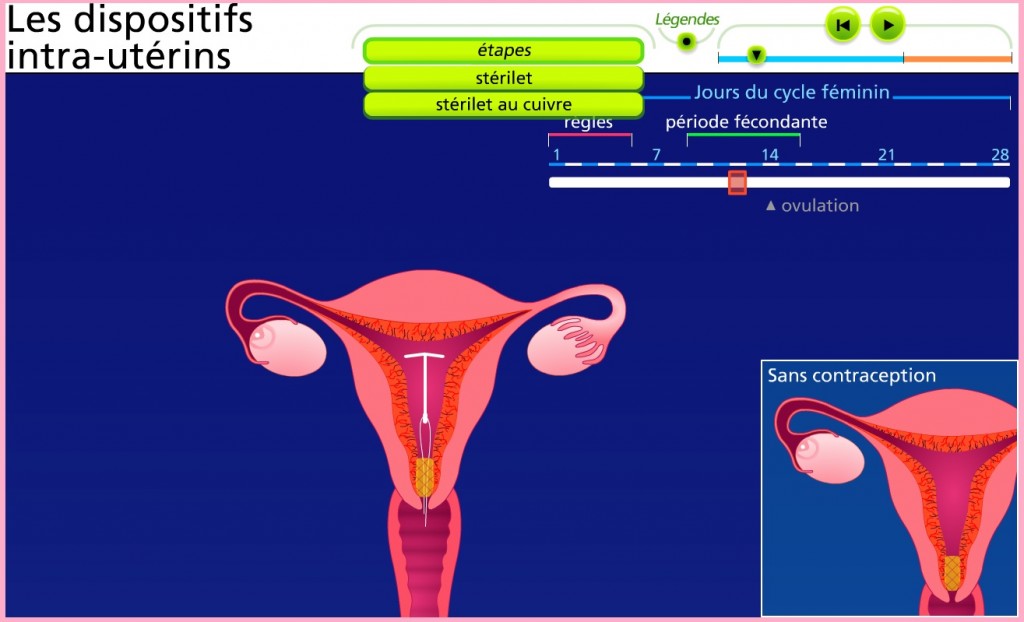 stérilets SVT contraception Vive les SVT ! Les sciences de la vie et de la Terre au collège et