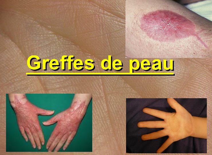 La greffe de peau