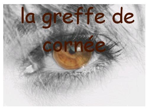 La greffe de cornée