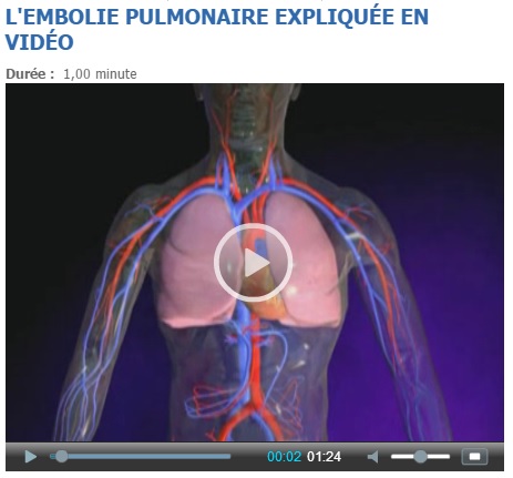 embolie pulmonaire