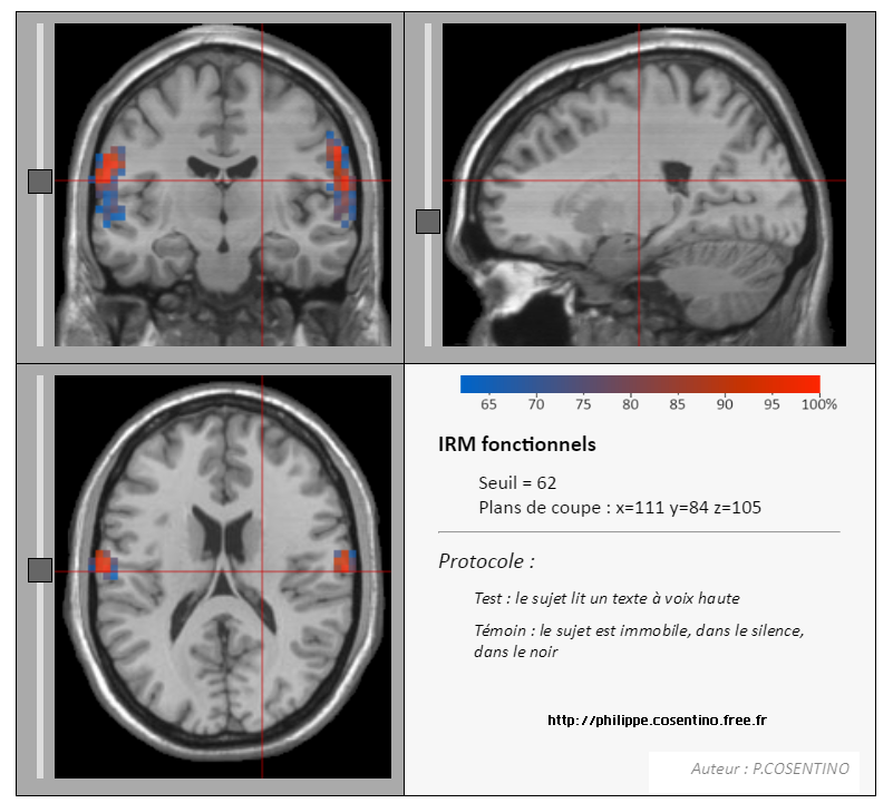 logiciel-irm-anatomique-svt-1ere-cerveau